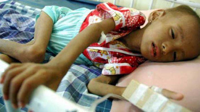 Ditelantarkan Orang Tua, Balita di Sumenep Menderita Gizi Buruk Ditelantarkan Orang Tua, Balita di Sumenep Menderita Gizi Buruk