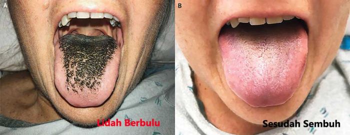 Masya Allah, Lidah Cewek Ini Tumbuh Bulu! Masya Allah, Lidah Cewek Ini Tumbuh Bulu!