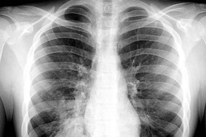 Pengertian, Penyebab dan Perbedaan Pneumonia dangan Asma Pengertian, Penyebab dan Perbedaan Pneumonia dangan Asma