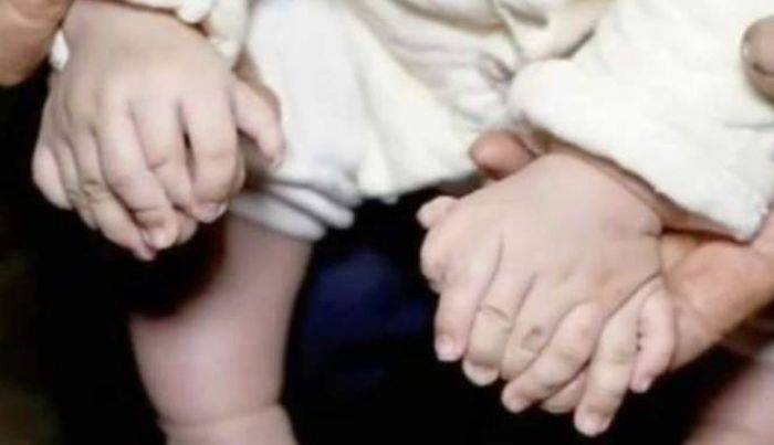 Bayi di Hongkong Lahir dengan 31 Jari Bayi di Hongkong Lahir dengan 31 Jari
