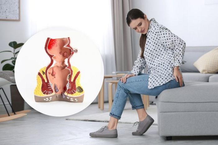 Bisakah Ambeien Sembuh Sendiri? Ini Penjelasannya Bisakah Ambeien Sembuh Sendiri? Ini Penjelasannya