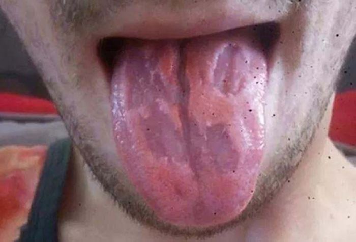 Waspada, Minuman Energi Bisa Bikin Lidah Melepuh Waspada, Minuman Energi Bisa Bikin Lidah Melepuh