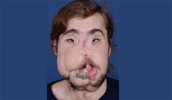 Tembak Kepala Sendiri Sebabkan Wajah Amburadul, Jalani Prosedur Face Off Pakai Wajah Orang Lain Tembak Kepala Sendiri Sebabkan Wajah Amburadul, Jalani Prosedur Face Off Pakai Wajah Orang Lain