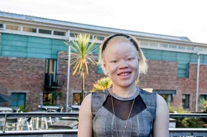 ​Dukun Afrika Incar Gadis Albino, Diambil Tulang dan Tubuhnya untuk Penguat Sihir
