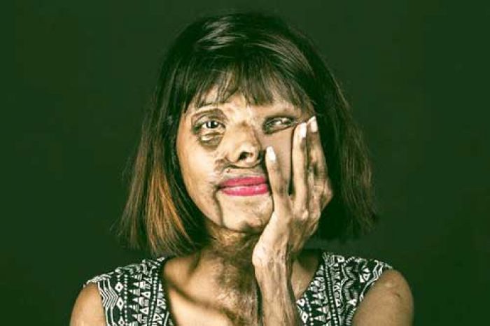 Anmol Rodrigous, Korban Wajah Disiram Air Keras yang Jadi Inspirasi Anmol Rodrigous, Korban Wajah Disiram Air Keras yang Jadi Inspirasi