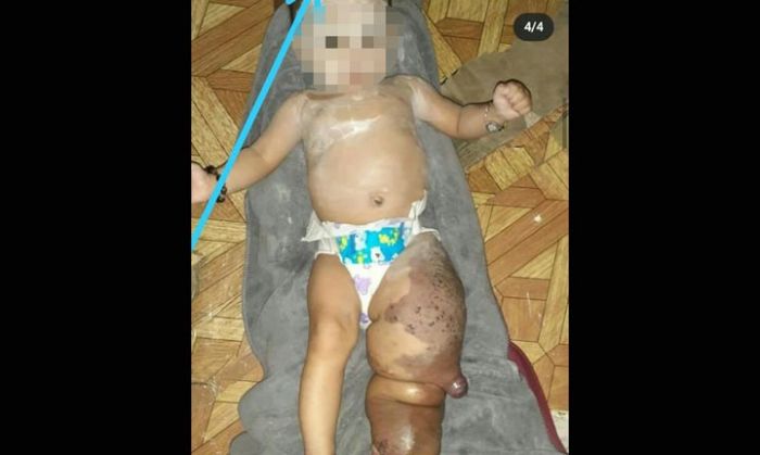 Bayi Penderita Lymphangioma di Pamekasan Membutuhkan Uluran para Dermawan