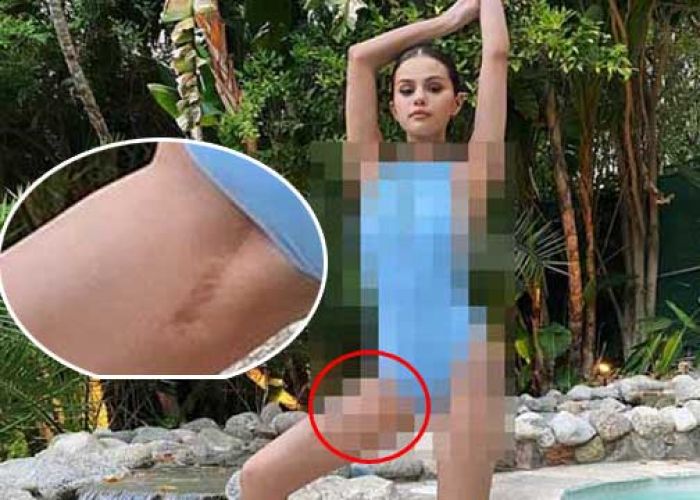 Selena Gomez Pamer Bekas Sayatan Operasi Transplantasi Ginjal Selena Gomez Pamer Bekas Sayatan Operasi Transplantasi Ginjal
