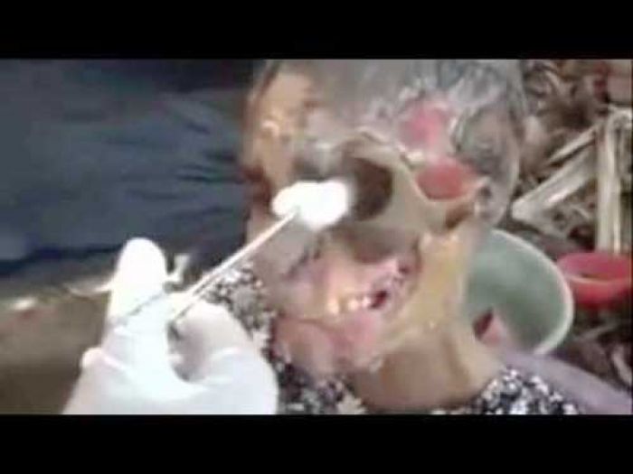 Krokodil, Narkoba Paling Mematikan! Bunuh Ribuan Pecandu dengan Kondisi Busuk dan Jadi Krokodil, Narkoba Paling Mematikan! Bunuh Ribuan Pecandu dengan Kondisi Busuk dan Jadi