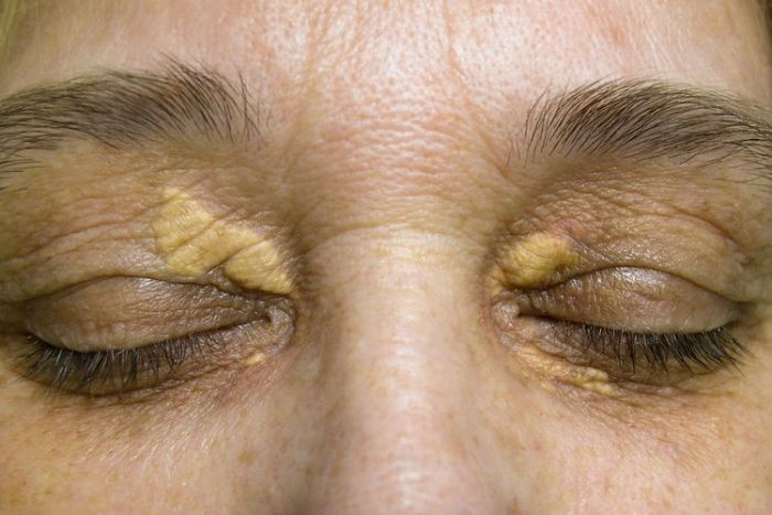 Gejala Xanthelasma dan Cara Mengatasinya Gejala Xanthelasma dan Cara Mengatasinya