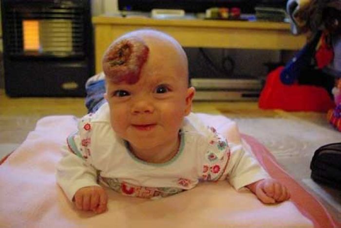 Bayi Ini Punya Tanda Lahir seperti Donat Strawberi, Sekarang Percaya Diri Bayi Ini Punya Tanda Lahir seperti Donat Strawberi, Sekarang Percaya Diri