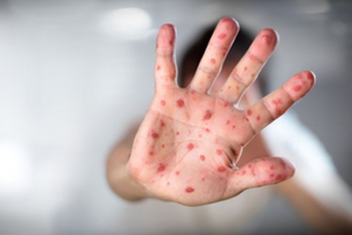 Cara Mencegah Flu Singapura Cara Mencegah Flu Singapura
