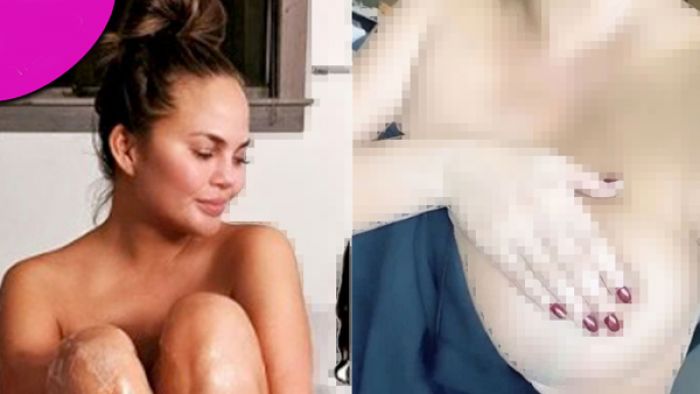Usai Implan Diangkat dari Payudara Diangkat, Tetap Seksi Usai Implan Diangkat dari Payudara Diangkat, Tetap Seksi