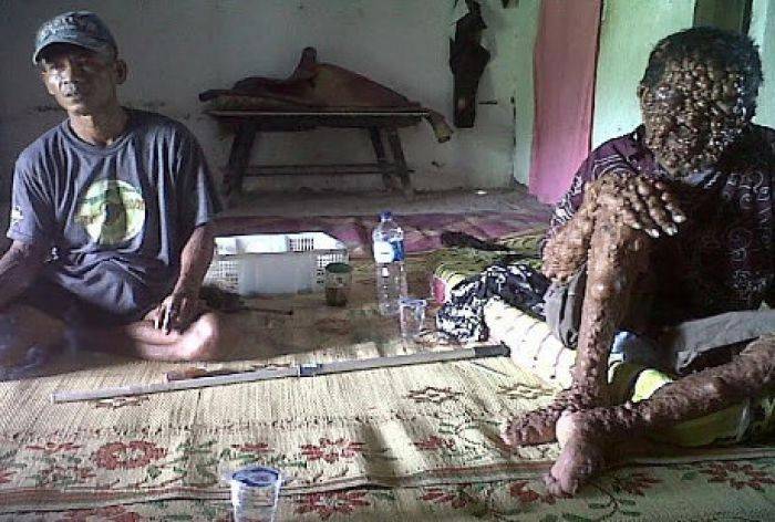 Wajah dan Sekujur Tumbuh Ditumbuhi Tumor, Keluarga Pria Magetan Ini Pasrah Wajah dan Sekujur Tumbuh Ditumbuhi Tumor, Keluarga Pria Magetan Ini Pasrah