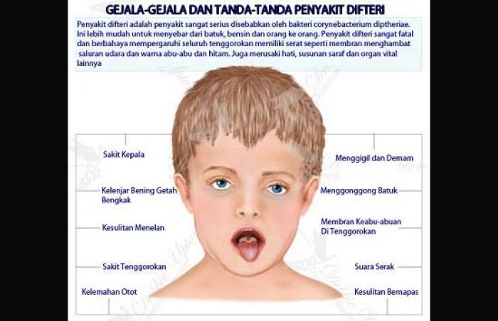 Waspada, Penyakit Difteri Bisa Sebabkan Kematian Waspada, Penyakit Difteri Bisa Sebabkan Kematian