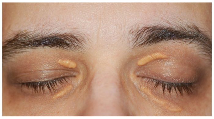 Penyebab Munculnya Xanthelasma, Bercak Warna Kuning di Sekitar Mata Penyebab Munculnya Xanthelasma, Bercak Warna Kuning di Sekitar Mata