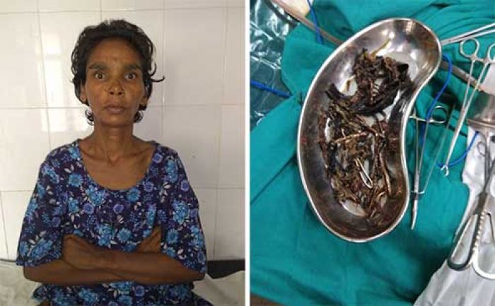 Suka Makan Benda Logam, Bikin Kepala Dokter Pusing 7 Keliling saat Operasi