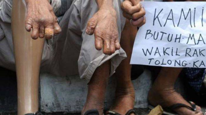 DPRD Jatim Usul Dirikan RS Kusta di Madura, Daerah Endemik Kusta Terbesar DPRD Jatim Usul Dirikan RS Kusta di Madura, Daerah Endemik Kusta Terbesar