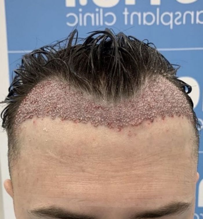 Transplantasi Rambut yang Gagal, Jadi Bikin Bergidik Transplantasi Rambut yang Gagal, Jadi Bikin Bergidik