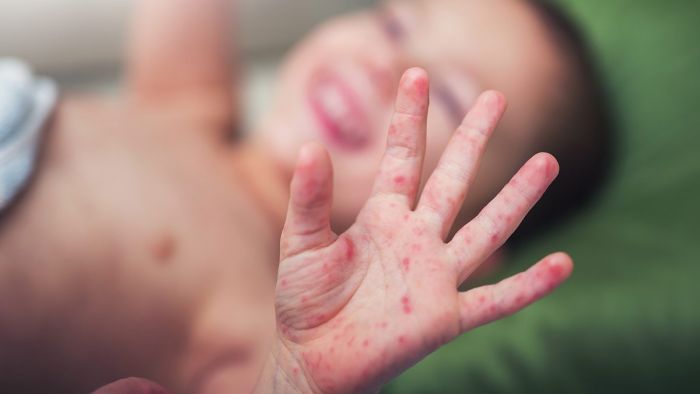 Belum Sepekan, Dua Balita di Pamekasan Terduga Campak Meninggal Dunia, Dinkes Ingatkan Imunisasi Belum Sepekan, Dua Balita di Pamekasan Terduga Campak Meninggal Dunia, Dinkes Ingatkan Imunisasi