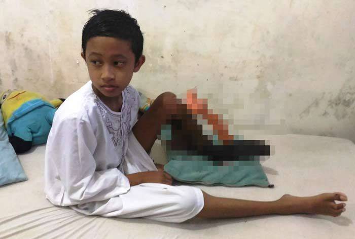 Kaki Pasien Alami Pembusukan Setelah 2 Kali Operasi, Ini Penjelasan RSSA Malang Kaki Pasien Alami Pembusukan Setelah 2 Kali Operasi, Ini Penjelasan RSSA Malang