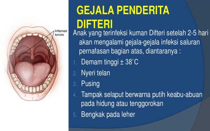 Bocah 11 Tahun di Tuban Meninggal Akibat Penyakit Difteri Bocah 11 Tahun di Tuban Meninggal Akibat Penyakit Difteri
