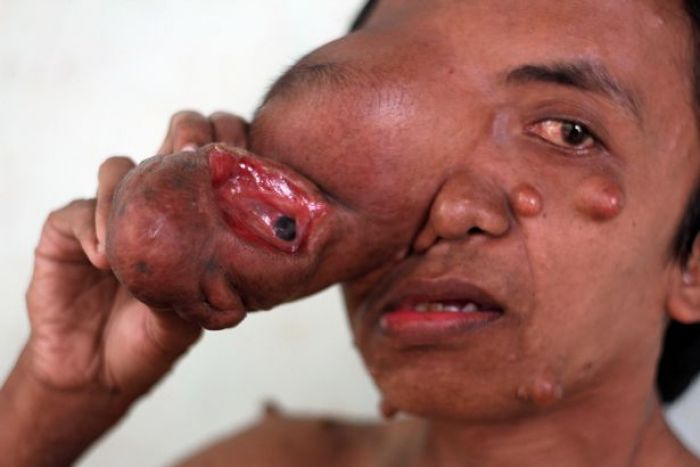Naudzubillah, Tumor Jadikan Satu Mata Herdi Firmansyah Menggantung Naudzubillah, Tumor Jadikan Satu Mata Herdi Firmansyah Menggantung