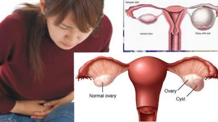 Kenali Gejala dan Bahaya Kista Ovarium Bagi Wanita