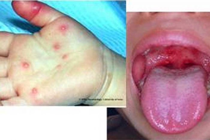 Cegah Penyebaran Flu Singapura, Dinkes Surabaya Imbau Masyarakat Terapkan PHBS Cegah Penyebaran Flu Singapura, Dinkes Surabaya Imbau Masyarakat Terapkan PHBS