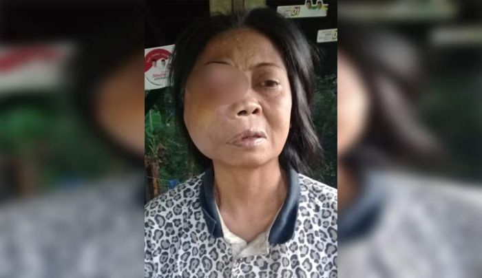 Jariah, Penderita Tumor Mata di Pacitan Belum Mendapatkan Bantuan Pengobatan Jariah, Penderita Tumor Mata di Pacitan Belum Mendapatkan Bantuan Pengobatan