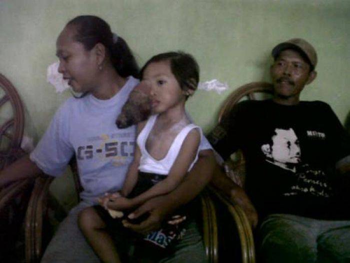 Derita Bocah Mojokerto Penderita Tumor Ganas Derita Bocah Mojokerto Penderita Tumor Ganas