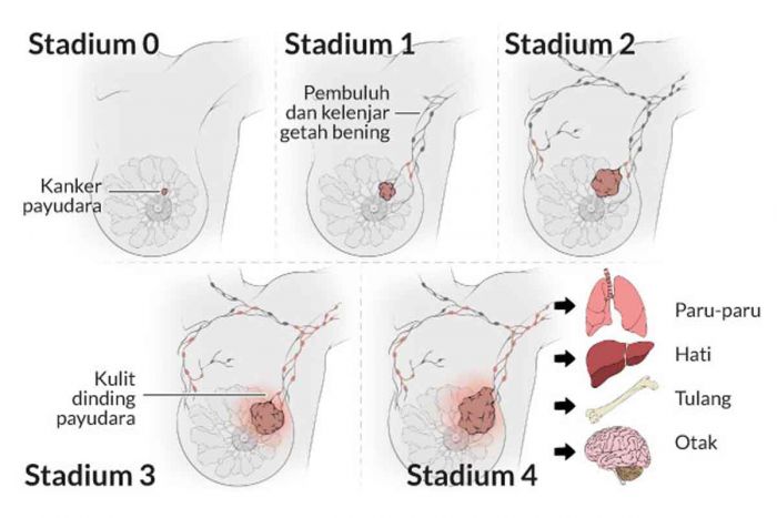 Ini Cara Cegah Kanker Payudara, Salah Satunya dengan Menyusui Ini Cara Cegah Kanker Payudara, Salah Satunya dengan Menyusui
