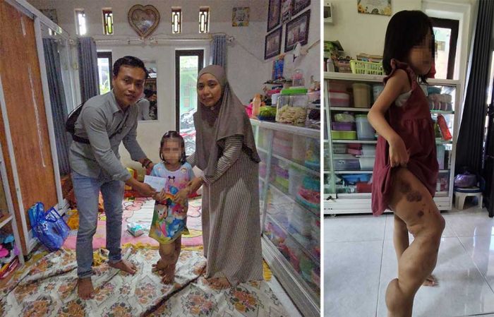 Idap Tumor Pembuluh Darah, Bocah 6 Tahun di Pamekasan Butuh Uluran Tangan Idap Tumor Pembuluh Darah, Bocah 6 Tahun di Pamekasan Butuh Uluran Tangan