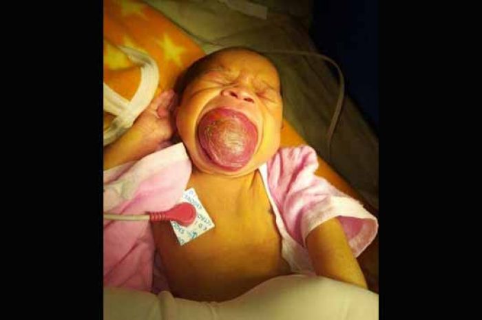 Naudzubillah, Bayi Lahir dengan Lidah Naudzubillah, Bayi Lahir dengan Lidah