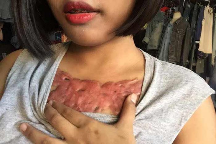 Ini Kengerian ketika Gambar Tato Dihapus dari Tubuh, Hiiii......... Ini Kengerian ketika Gambar Tato Dihapus dari Tubuh, Hiiii.........