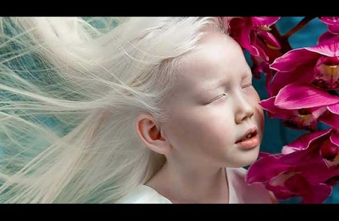 Nariyana, Gadis Albino, Ubah Kekurangan Jadi Kelebihan yang Mendunia