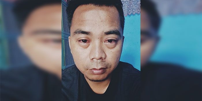Salah satu penderita penyakit mata memerah di Kabupaten Sampang, Moh Heri. Foto: MUTAMMIM/BANGSAONLINE