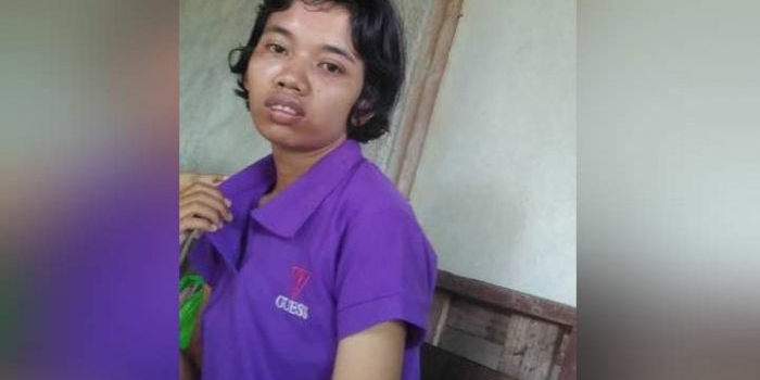 Yuli, gadis penderita epilepsi dan luka bakar yang nunggak BPJS.