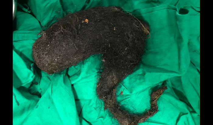 Rambut yang dikeluarkan dari perut si ABG. foto: repro mirror.co.uk