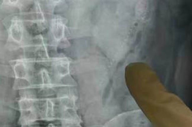 Dokter menunjukkan ikan yang berenang dan hidup dalam usus pasien. foto: repro mirror.co.uk