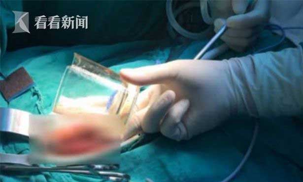 Dokter berhasil mengeluarkan gelas dari perut pasien dalam kondisi tidak pecah. foto: mirror.co.uk