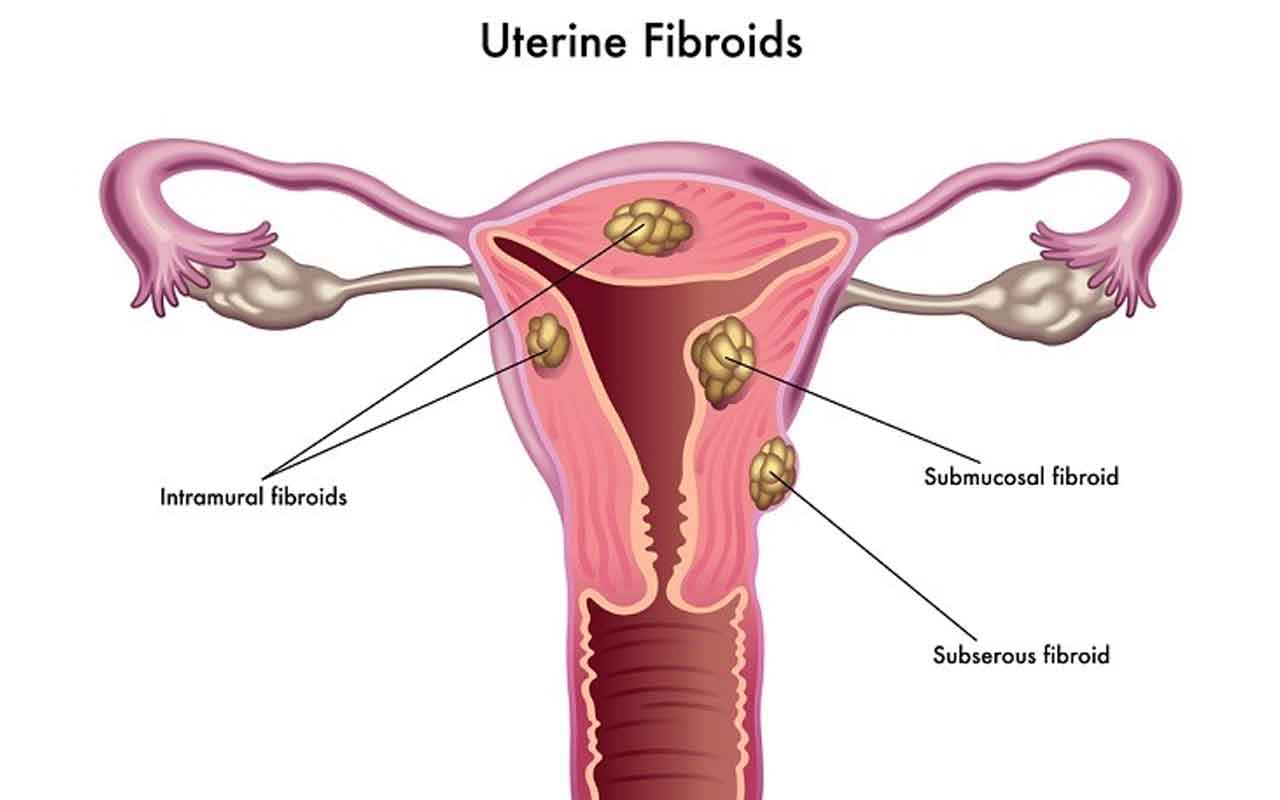 Fibroid Rahim.
